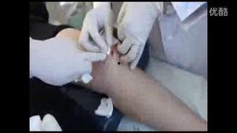 微针刀视频,微针刀操作技巧与临床应用揭秘