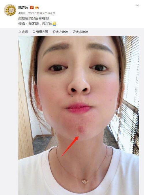 男明星皮肤长痘痘,揭秘明星护肤秘籍